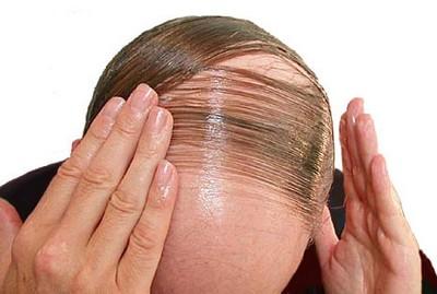اطلاعاتی درباره ریزش مو یا آلوپسی