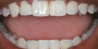 128 691 200x100 - چند روش برای سفید کردن دندانها