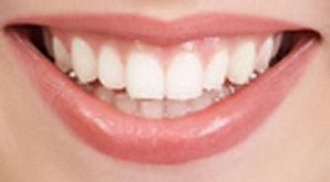 سفیدی دندان