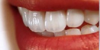 L125355884888 200x100 - نخ دندان