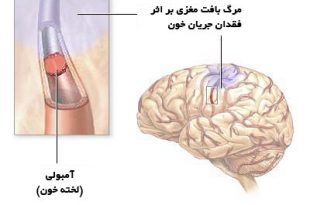 علل و عوامل سکته مغزی