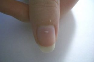 nail white spot 310x205 - دلیل ایجاد لکه سفید روی ناخن