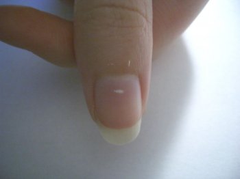 nail white spot - دلیل ایجاد لکه سفید روی ناخن