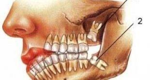 dandan aghl 310x165 - عوارض دندان عقل چیست