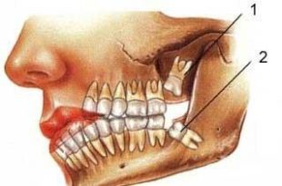 dandan aghl 310x205 - عوارض دندان عقل چیست