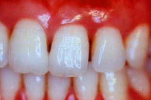 gum disease 310x205 - نکاتی برای داشتن لثه های سالم