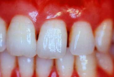 gum disease - نکاتی برای داشتن لثه های سالم