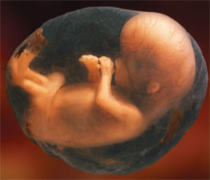 Poisoning Pregnancy - مسمومیت حاملگی
