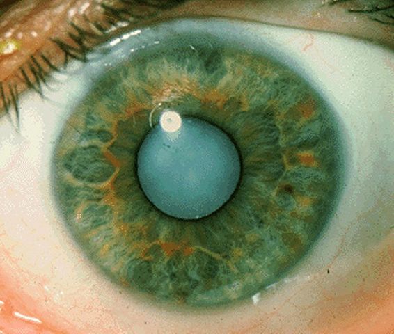 Cataract - معرفی بیماری چشمی آب مروارید