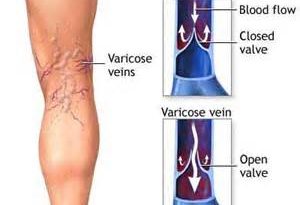 Varicose veins1 300x205 - مقاله درباره واریس
