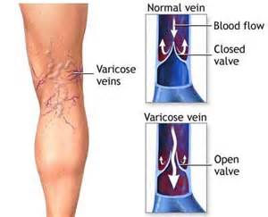 Varicose veins1 - مقاله درباره واریس