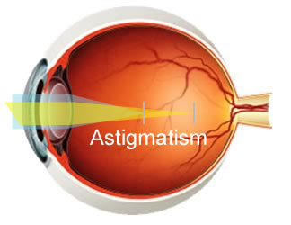 astigmatism - ویتامینهای مفید برای آستیگماتیسم