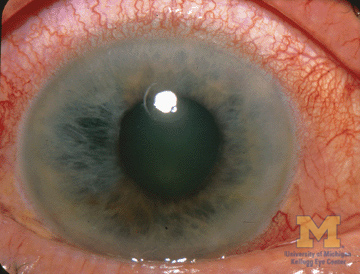 glaucoma - بیماری آب سیاه چشمی چیست