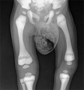مرمری - بیماری استئوپتروز یا استخوان مرمری چیست