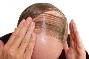 اطلاعاتی درباره ریزش مو یا آلوپسی