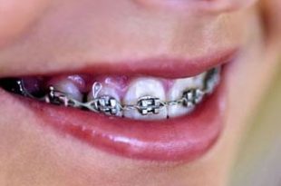 نکاتی درباره ارتودنسی دندان