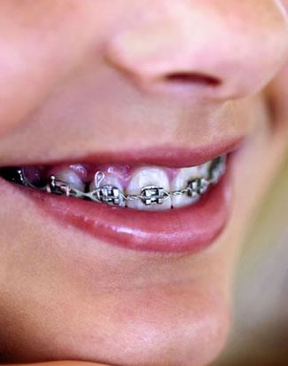 ortho - نکاتی درباره ارتودنسی دندان