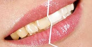 download 14 310x158 - دندانهای براق داشته باشیم