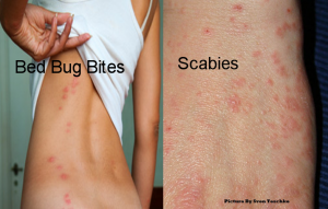 Bed-Bug-Bites-VS-Scabies