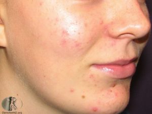 acne face 6 4 300x225 - اکنه