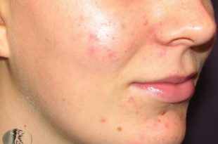 acne face 6 4 310x205 - اکنه