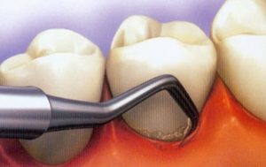 hhh1323 300x189 - پیشگیری از لق شدن دندان