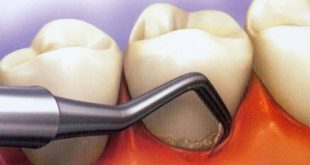 hhh1323 310x165 - پیشگیری از لق شدن دندان