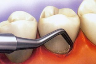 hhh1323 310x205 - پیشگیری از لق شدن دندان