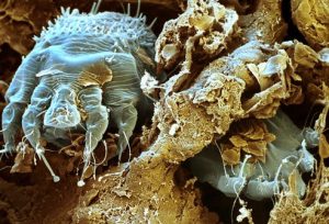 pictures of scabies infestation 300x204 - گال