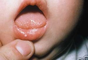 ba1891 300x204 - درمان برفک دهان کودکان