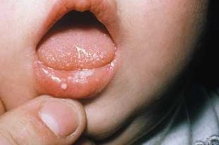 ba1891 310x205 - درمان برفک دهان کودکان