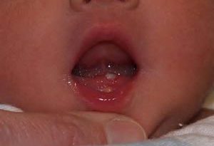 ba2258 300x205 - نوزادانی که موقع تولد دندان دارند