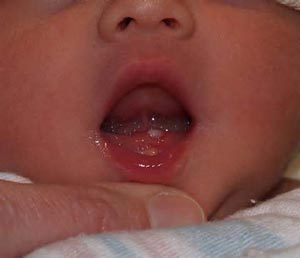 ba2258 300x258 - نوزادانی که موقع تولد دندان دارند