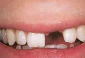 he2130 300x205 - درمان بی دندانی با بریج
