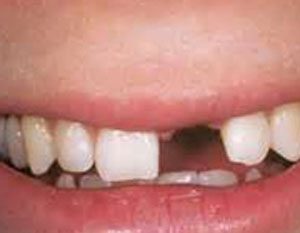 he2130 300x233 - درمان بی دندانی با بریج