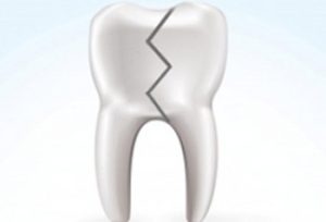 he2478 300x204 - علت شکستگی ناگهانی دندان