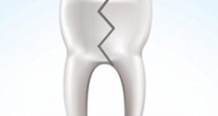 he2478 310x165 - علت شکستگی ناگهانی دندان