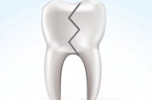 he2478 310x205 - علت شکستگی ناگهانی دندان